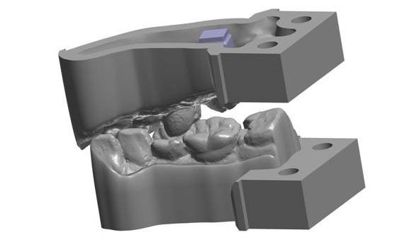 齿科3D打印